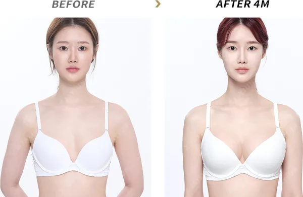 Before/After