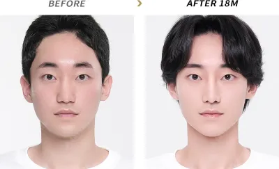Before & After
