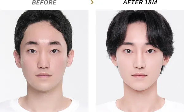 Before/After