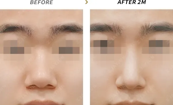 Before/After