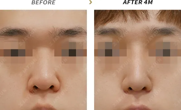 Before/After