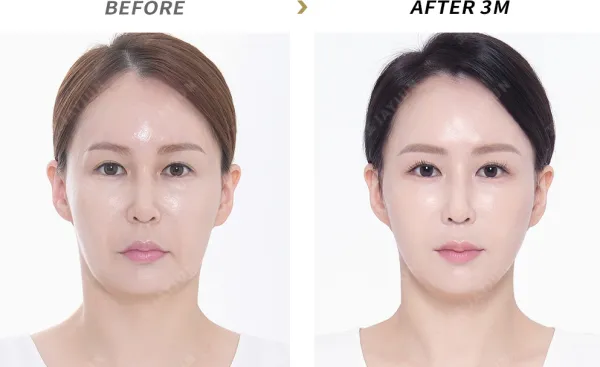 Before/After