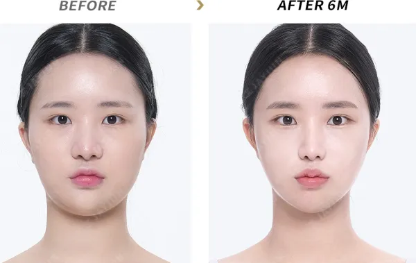 Before/After