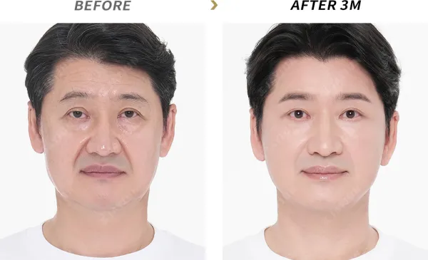 Before/After