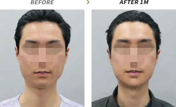 Before/After