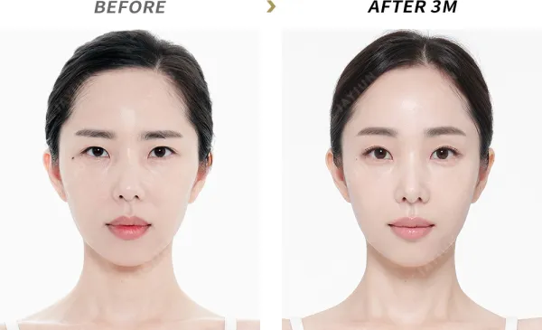 Before/After