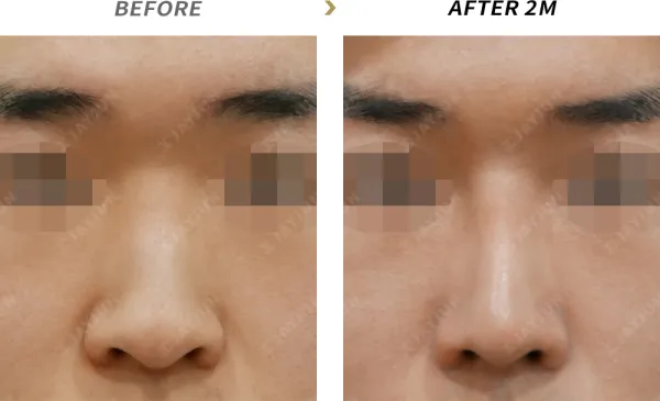 Before/After