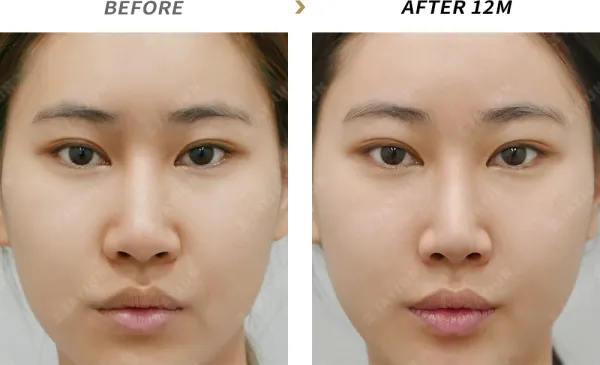 Before/After