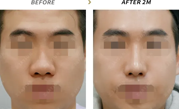 Before/After
