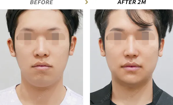 Before/After