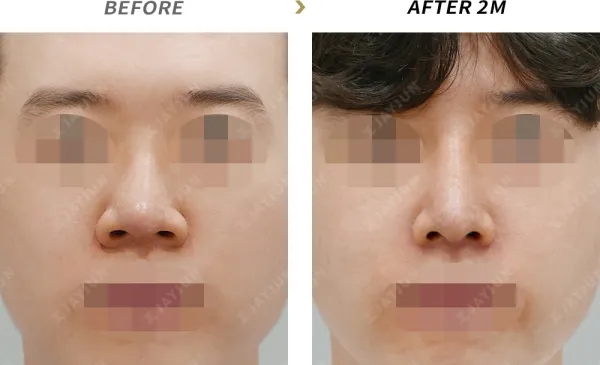 Before/After