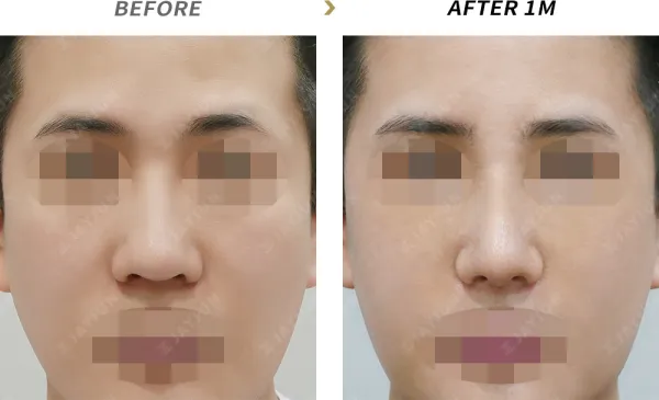 Before/After