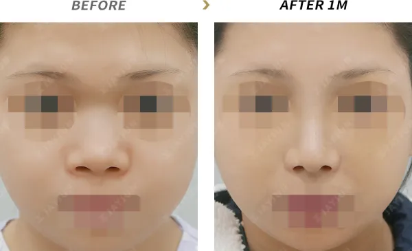 Before/After