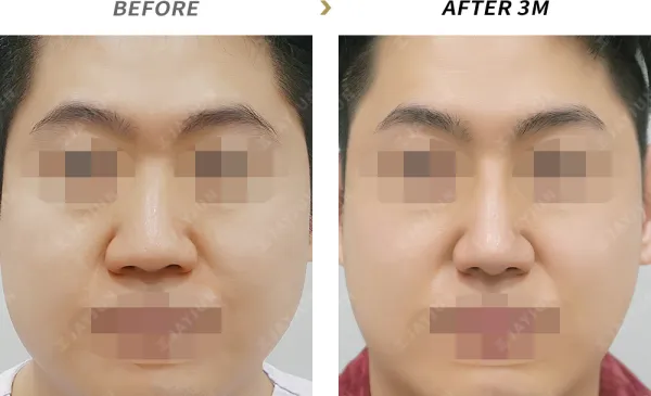 Before/After