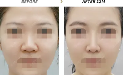 Before & After