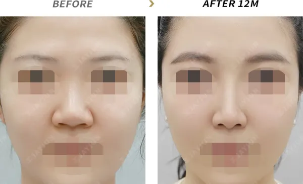 Before/After