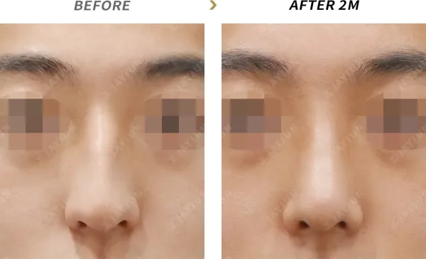 Before/After