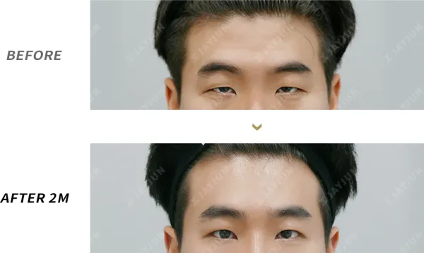 Before/After