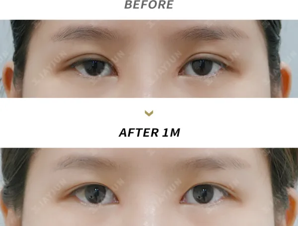 Before/After