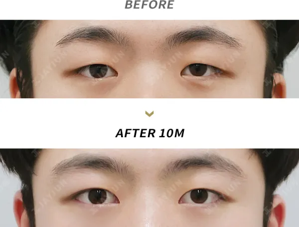 Before/After
