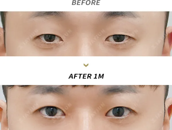 Before/After