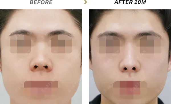 Before/After