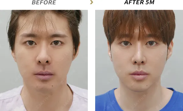 Before/After