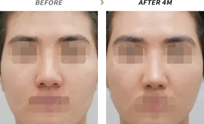 Before & After