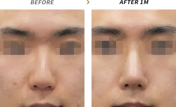 Before/After