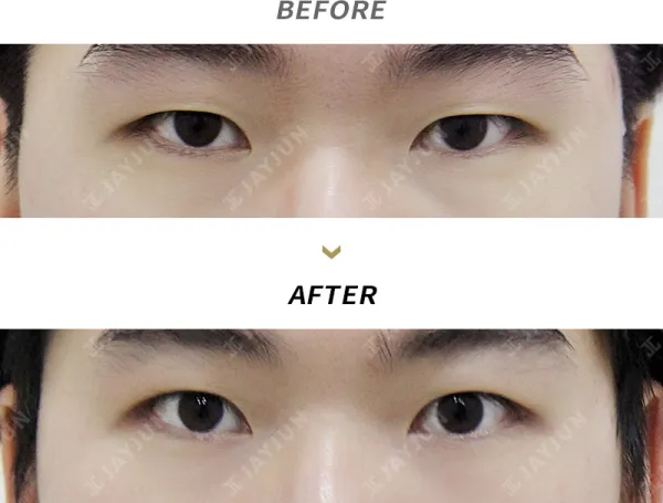 Before/After