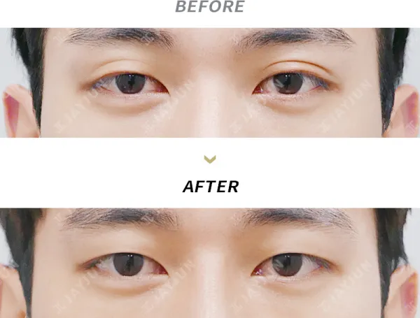 Before/After