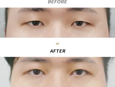 Before & After