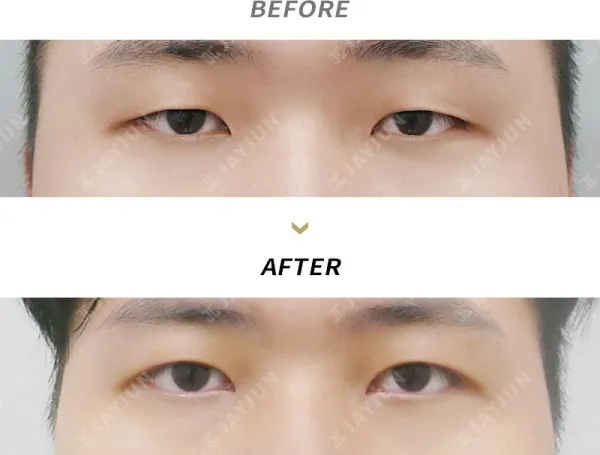 Before/After