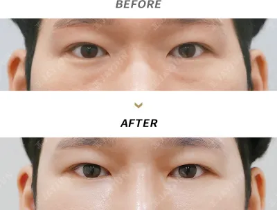 Before & After