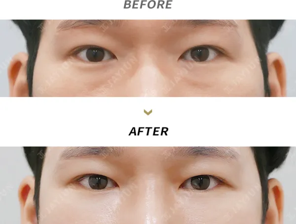 Before/After
