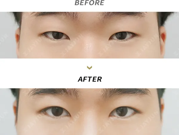 Before/After
