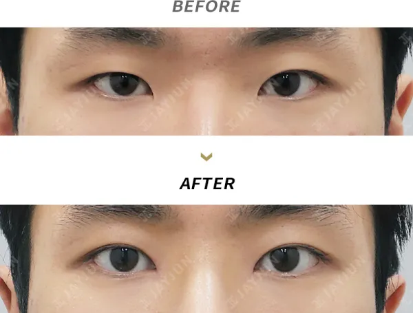Before/After