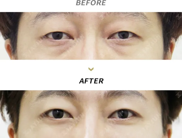 Before/After