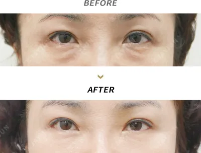 Before & After