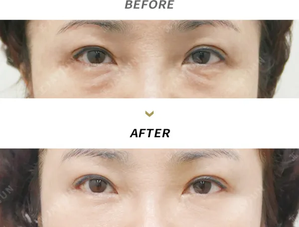 Before/After
