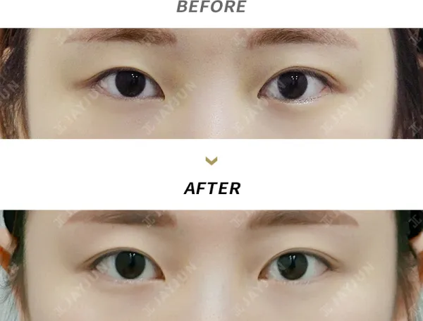 Before/After