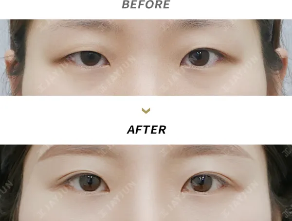 Before/After