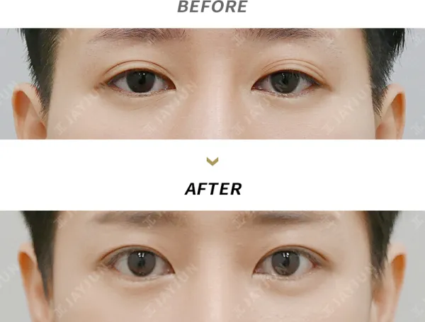 Before/After
