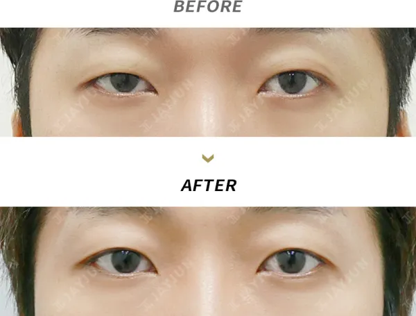 Before/After