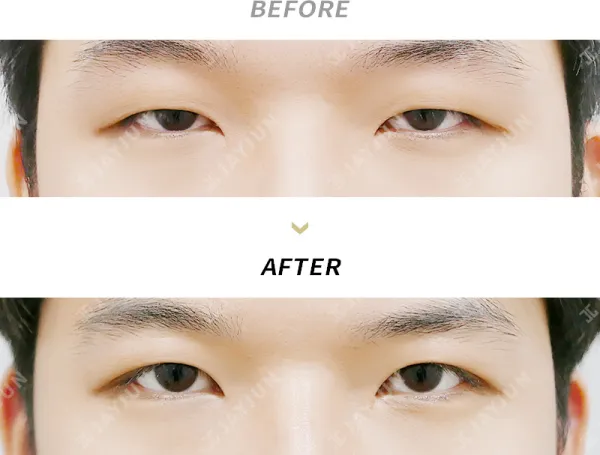 Before/After