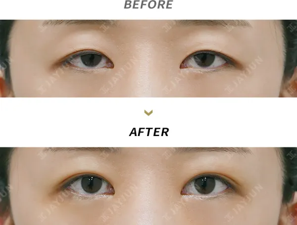Before/After