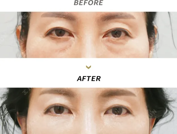 Before/After