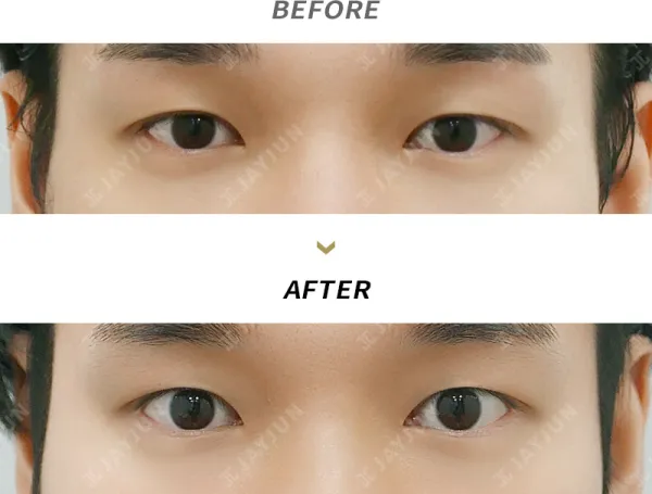 Before/After