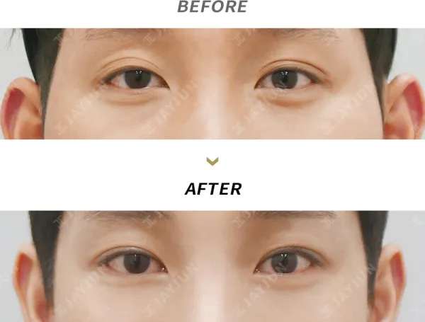 Before/After