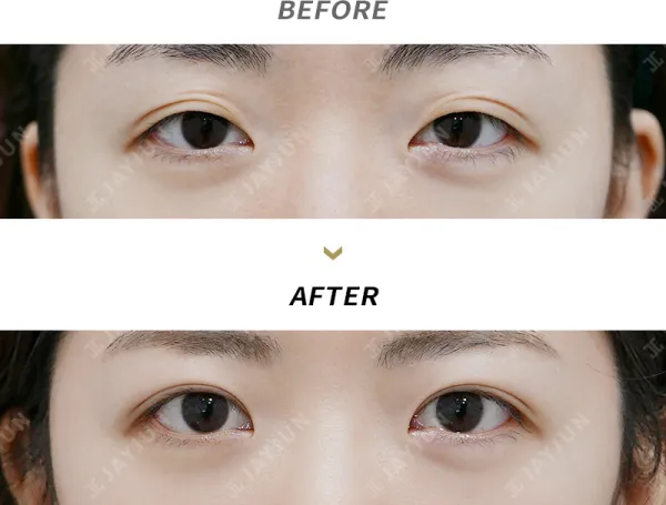 Before/After
